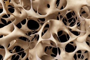 Osteoporosis is a Silent Disease